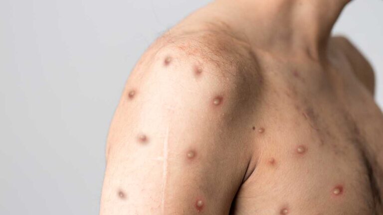 Europa registra 23 mil casos de Viruela del mono