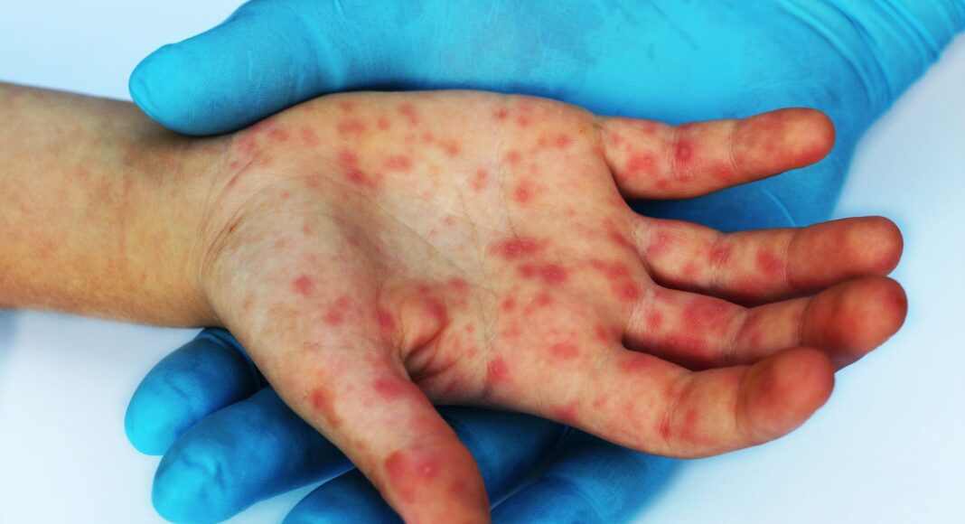 Aumentan casos de sarampión en 2026