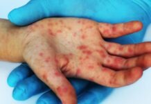 Aumentan casos de sarampión en 2026