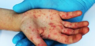 Aumentan casos de sarampión en 2026