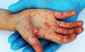 Aumentan casos de sarampión en 2026