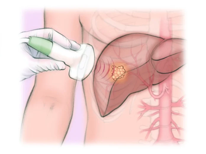 liver_tumor_ablation_1